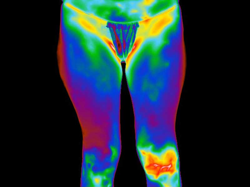 Thermogram of patient with left knee trauma