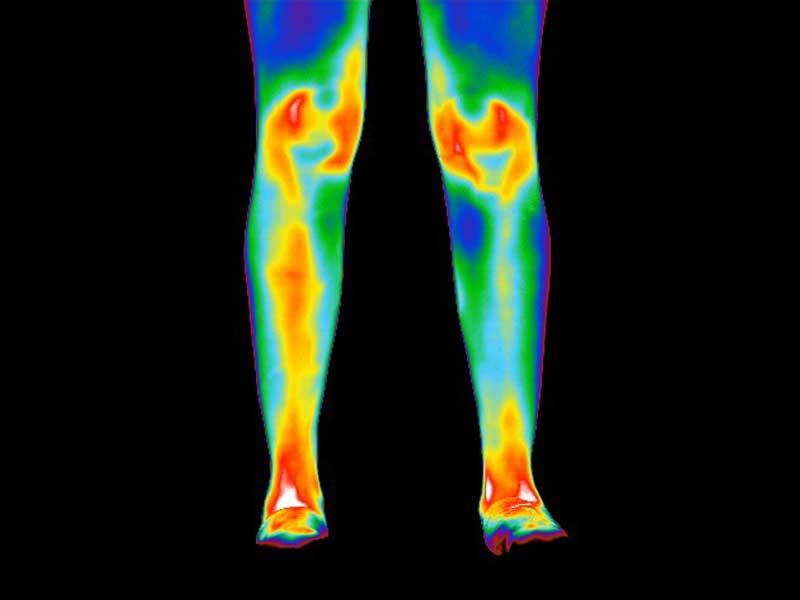 Thermogram of legs of patient with rheumatoid arthritis