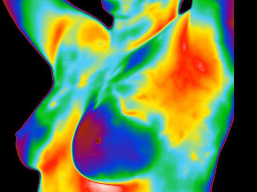 A breast thermogram